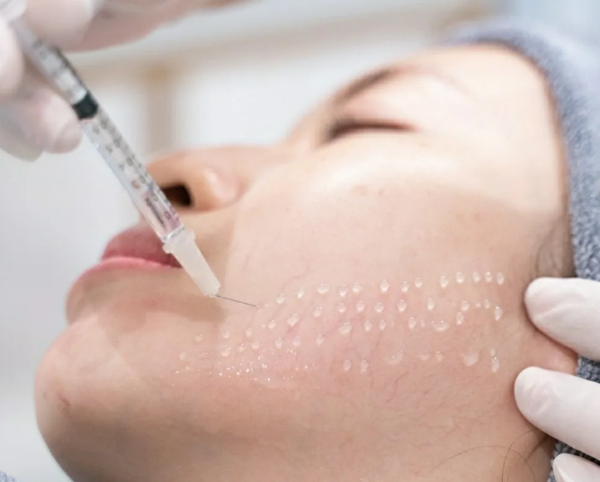 Regional Spotlight Divergent Paths in Mesotherapy Adoption Rehional a Spotlight Divergent a Dalan iti Panag-ampon ti Mesotherapy .