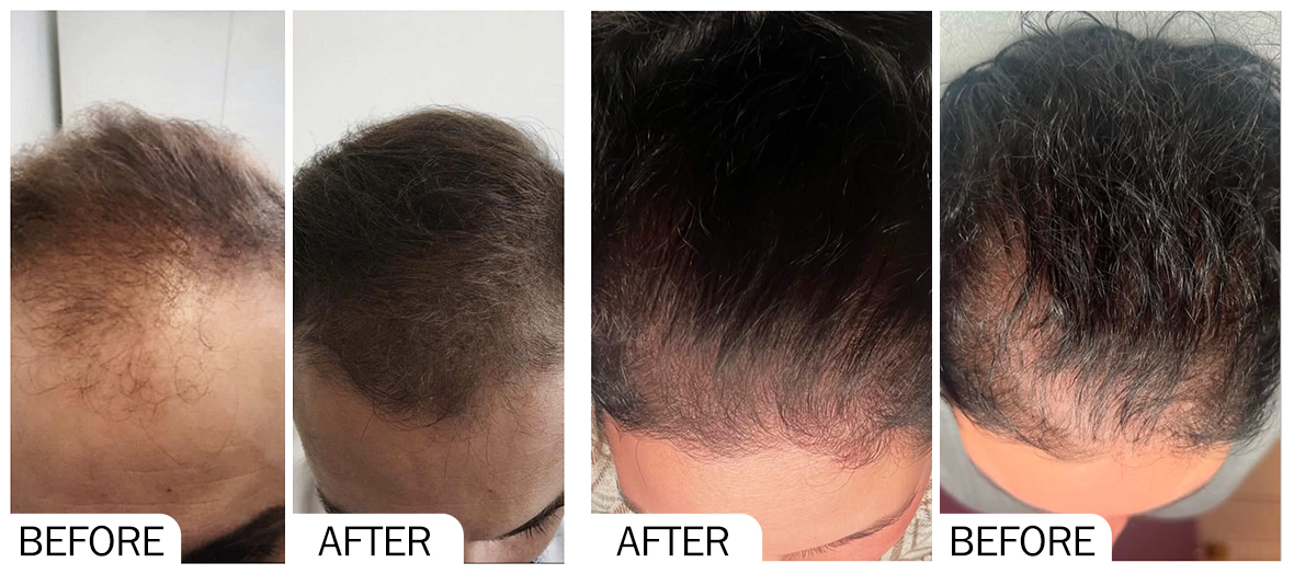 Before & After pictures of AOMA HAIR GROWTH-pdrn Pamaso & Pambuyo zithunzi za AOMA HAIR GROWTH-pdrn