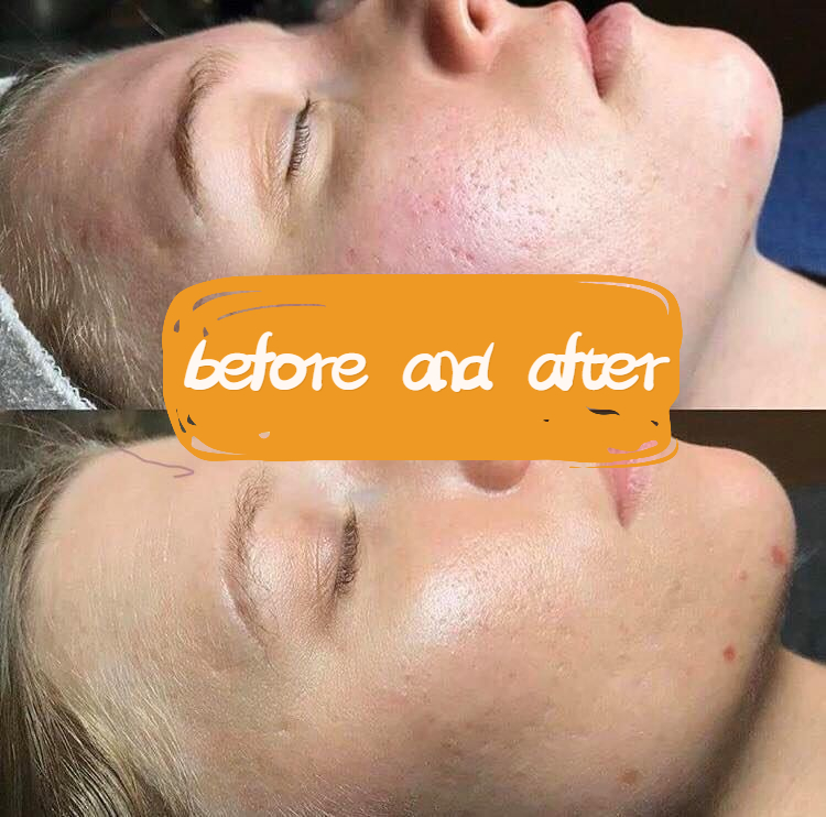 AOMA Skin Rejuvenation Before-and-after AOMA Skin Rejuvenation Before-and-after