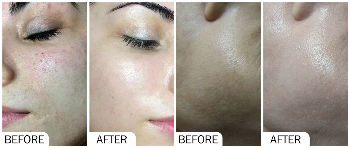 Before and After Skin Whitening AOMA Арьс цайруулахын өмнө ба дараа AOMA