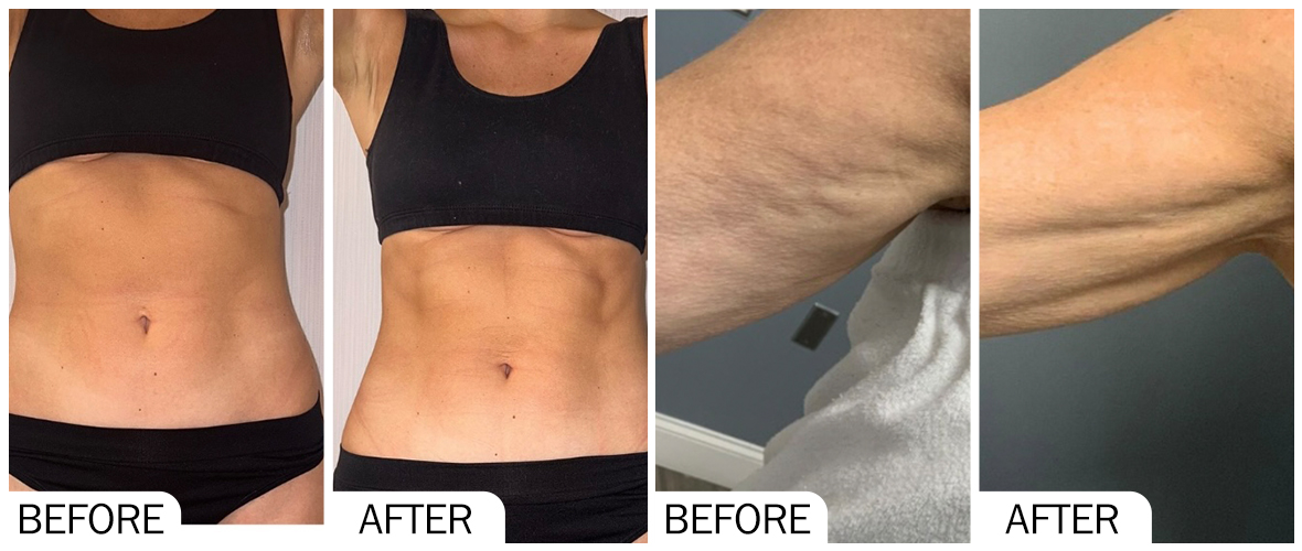 Before & After pictures of AOMA Fat-X solution AOMA Fat-X ھەل قىلىش چارىسىنىڭ ئالدى-كەينىدىكى رەسىملىرى