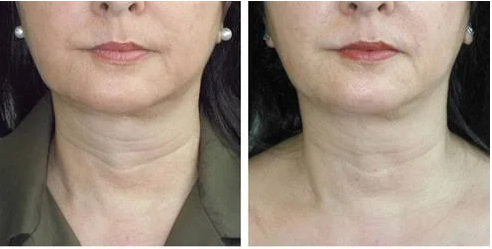 AOMA Collagen Lift before after AOMA Collagen Lift before after