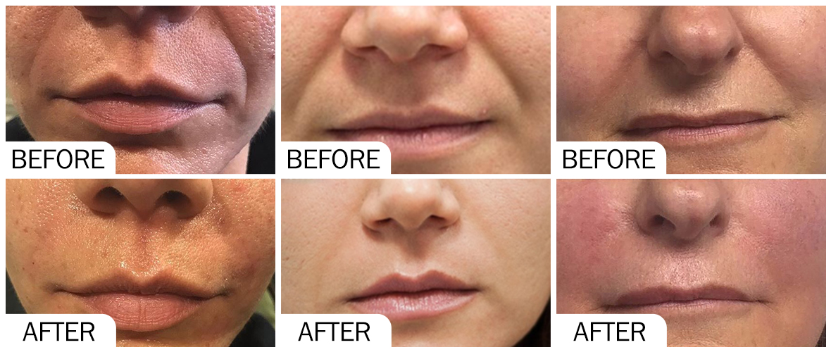 Before and After Facial Wrinkle-plus- AOMA Пре и после бора на лицу-плус- АОМА