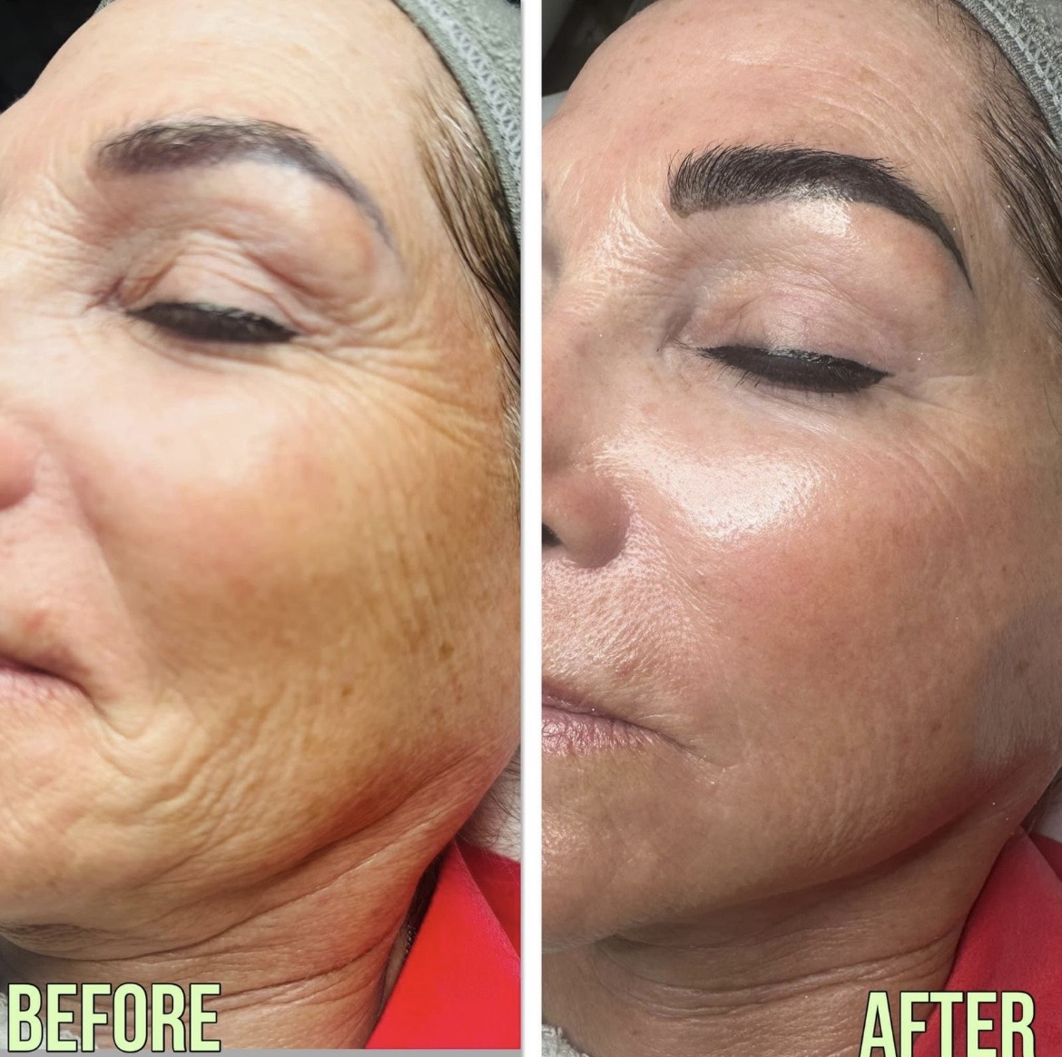 AOMA SKIN REJUVENATION Long-term results of Mesotherapy RAJEUNISSEMENT DE LA PEAU AOMA Résultats à long terme de la mésothérapie