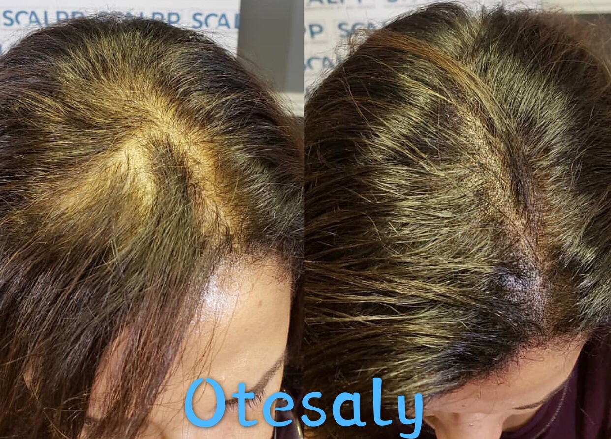 Anti-Hair Loss Mesotherapy Case Results AOMA Anti-Hair Loss Mesotherapy Case Results AOMA