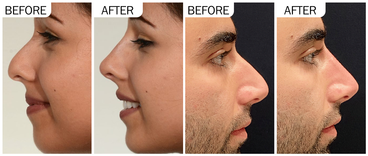 nose filler Nasenfüller