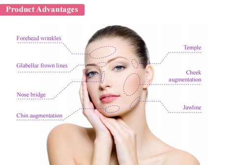 Dermal filler injection areas.png