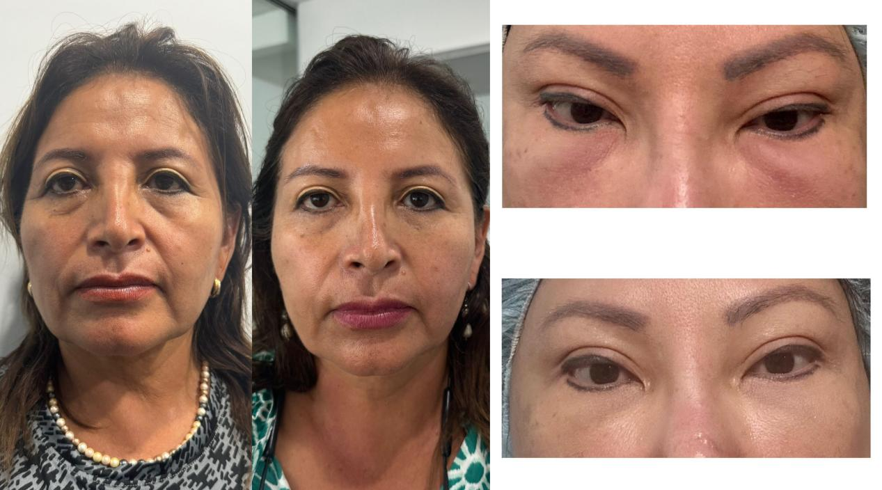 Before & After Pictures of PLLA Filler