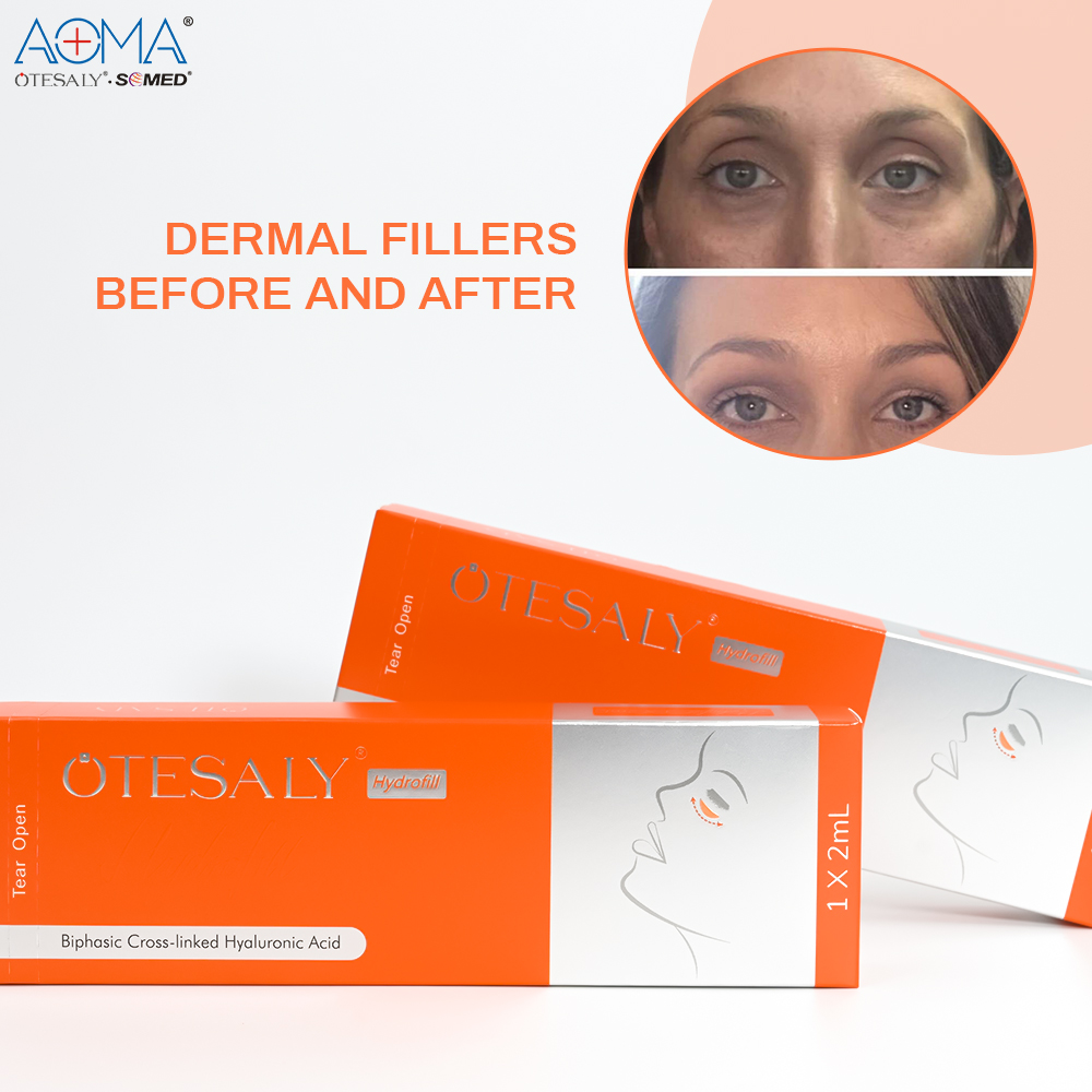 AOMA Hydrofill Dermal Filler