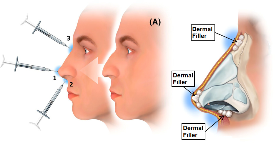Dermal Filler Treatment Area