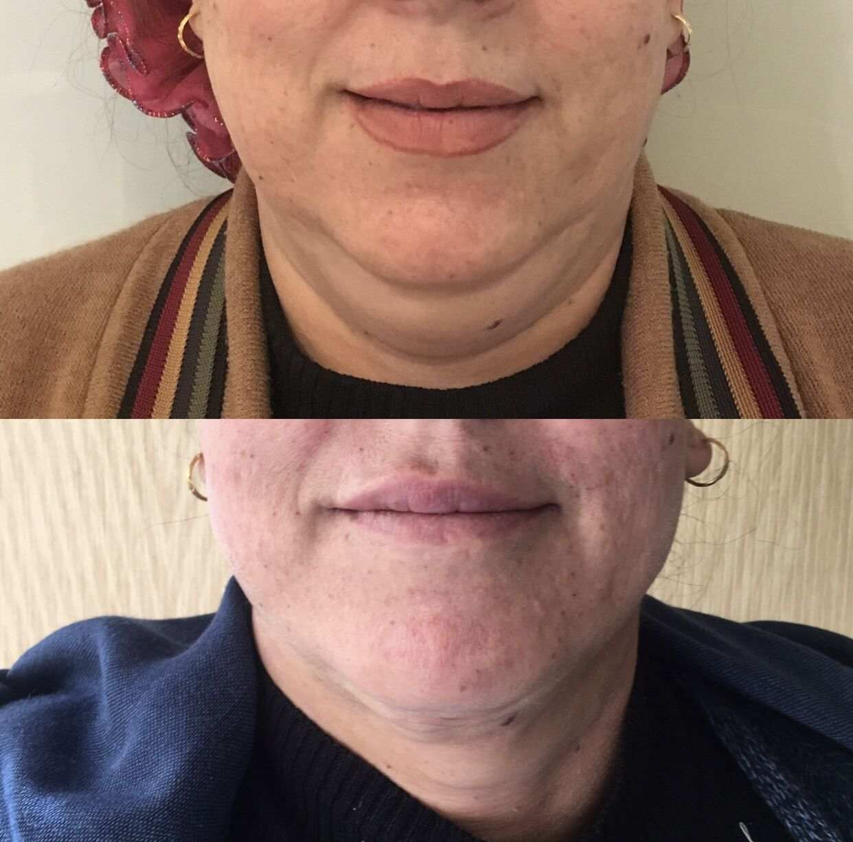 after before gallery mesotherapy injections