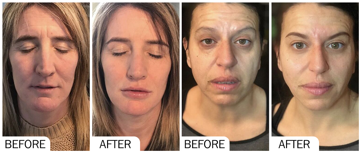 Before and After Facial Filler AOMA