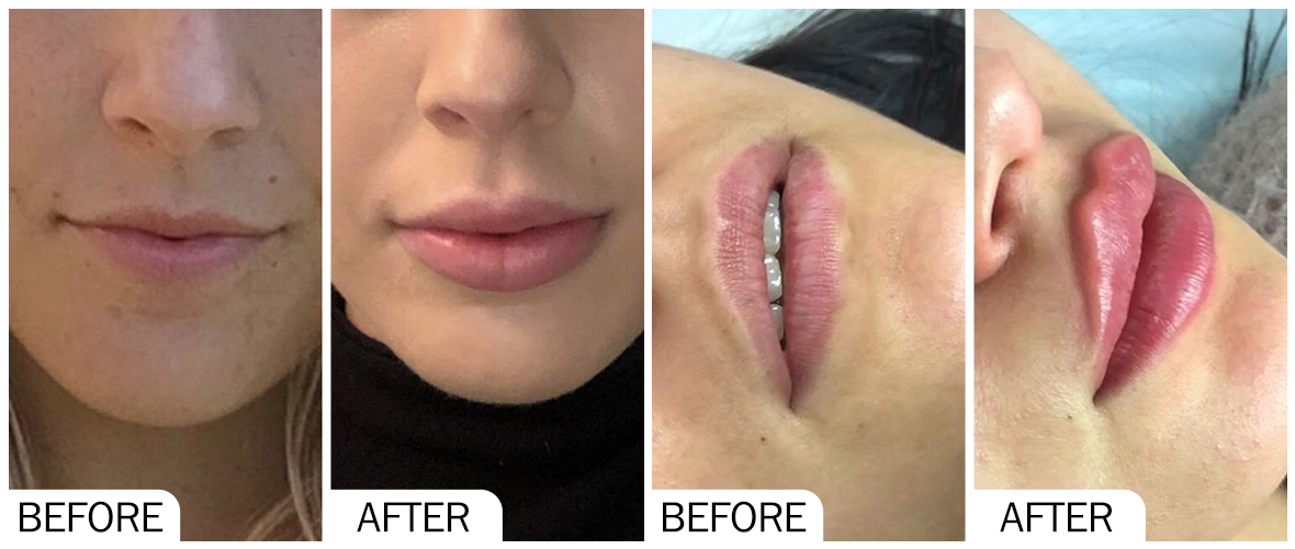 Before and After Lip filler AOMA