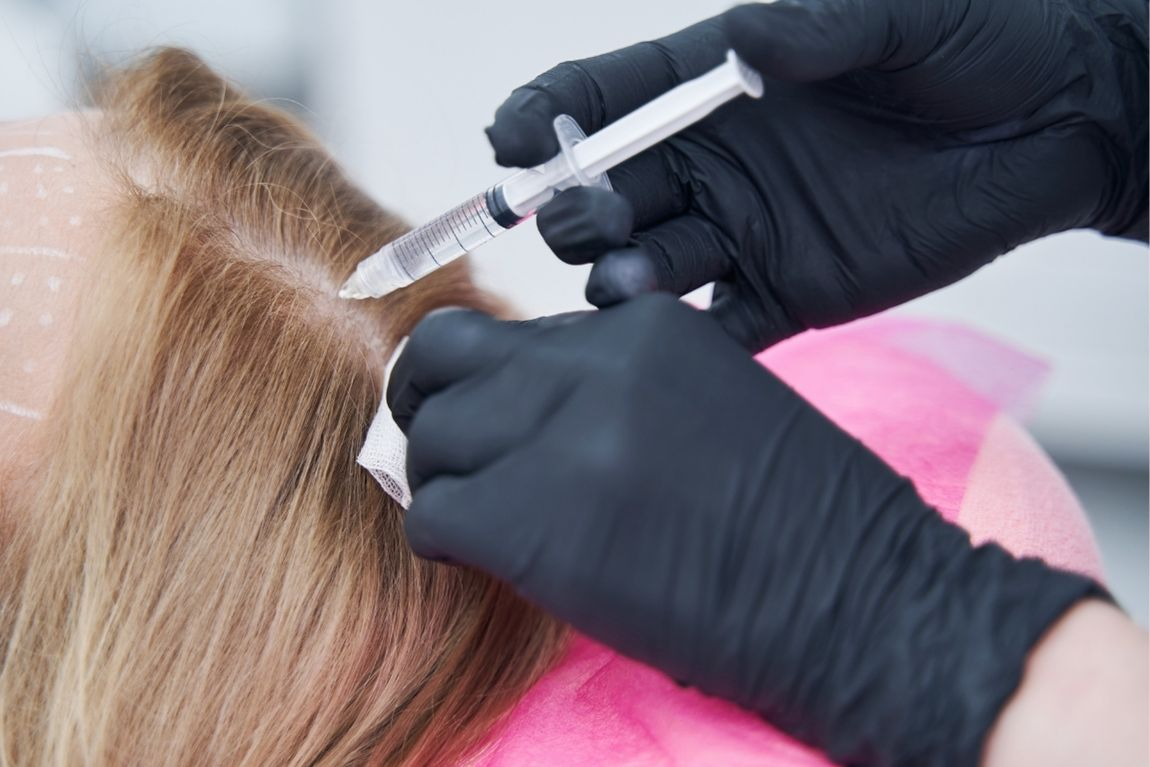 Anti-hair Loss Mesotherapy