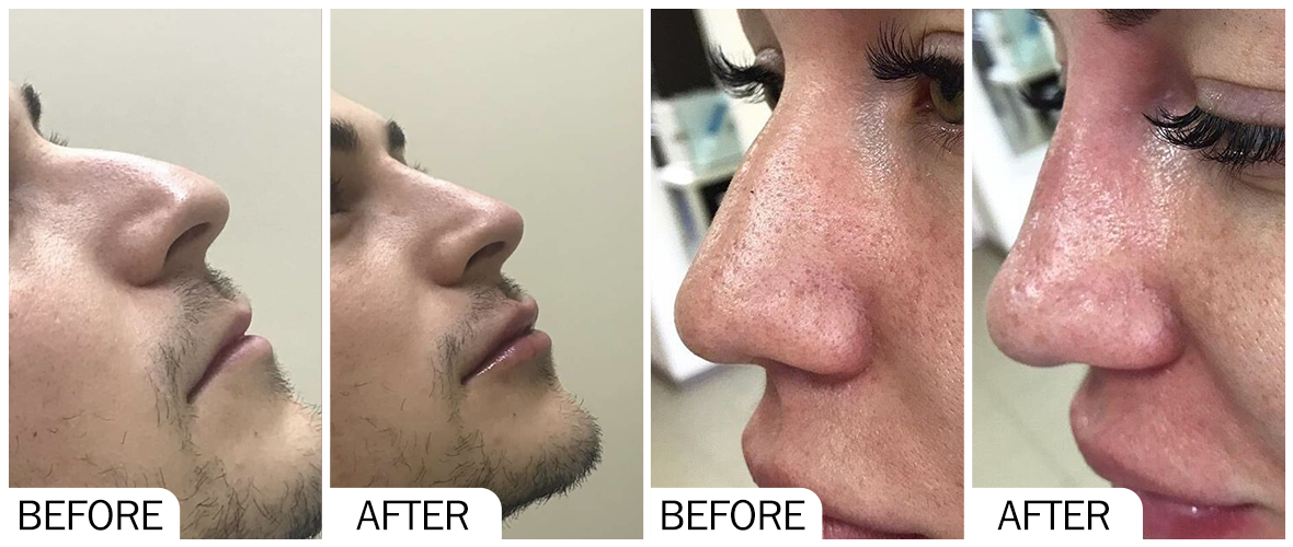 Before and After Nose Enlargement AOMA