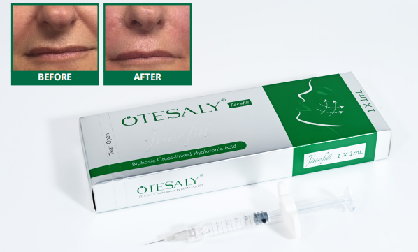 Best Fillers for Smile Lines