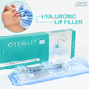 2 ml di riempimentu di labbra &agrave; l'acidu hyaluronicu per rinfurz&agrave; u voluminu di e labbra &egrave; l'effettu riduttu