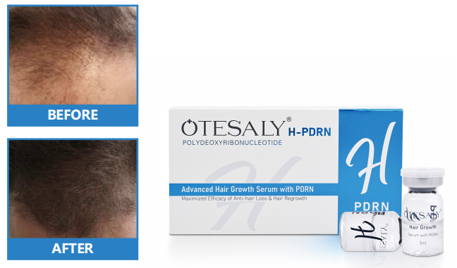 mesotherapy for hair
