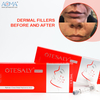 2ml Lidocaine Dermal Filler pikeun Jawline Enhancement OEM Sadia