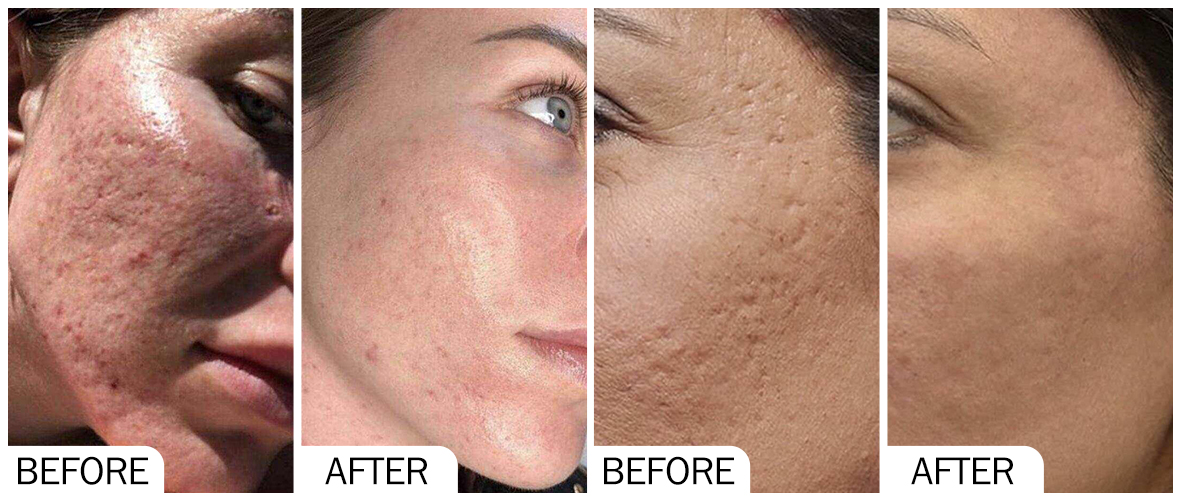 Before and After Skin Rejuvenation AOMA