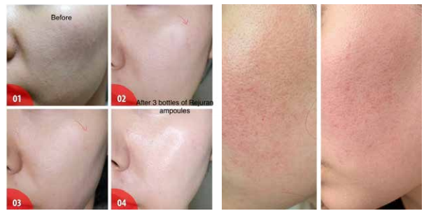Before & After pictires of AOMA PDRN