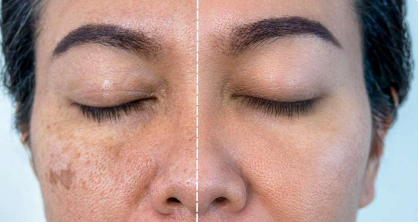 skin whitening mesotherapy case study