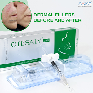 Anti-Wrinkle 1ml Hyaluronic Acid Filler Injections Temples