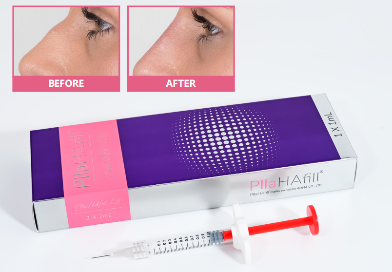 PLLA collagen injection