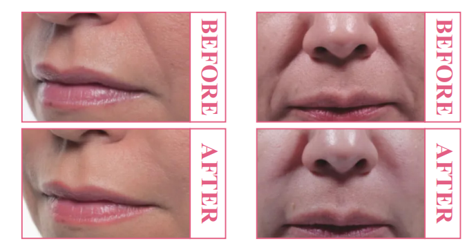 Before & after pictures of filler injection