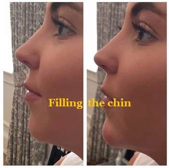 Filling The Chin For AOMA