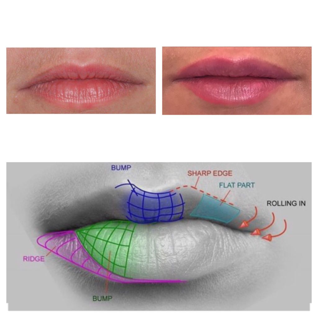 Lipfill 1ml After before AOMA