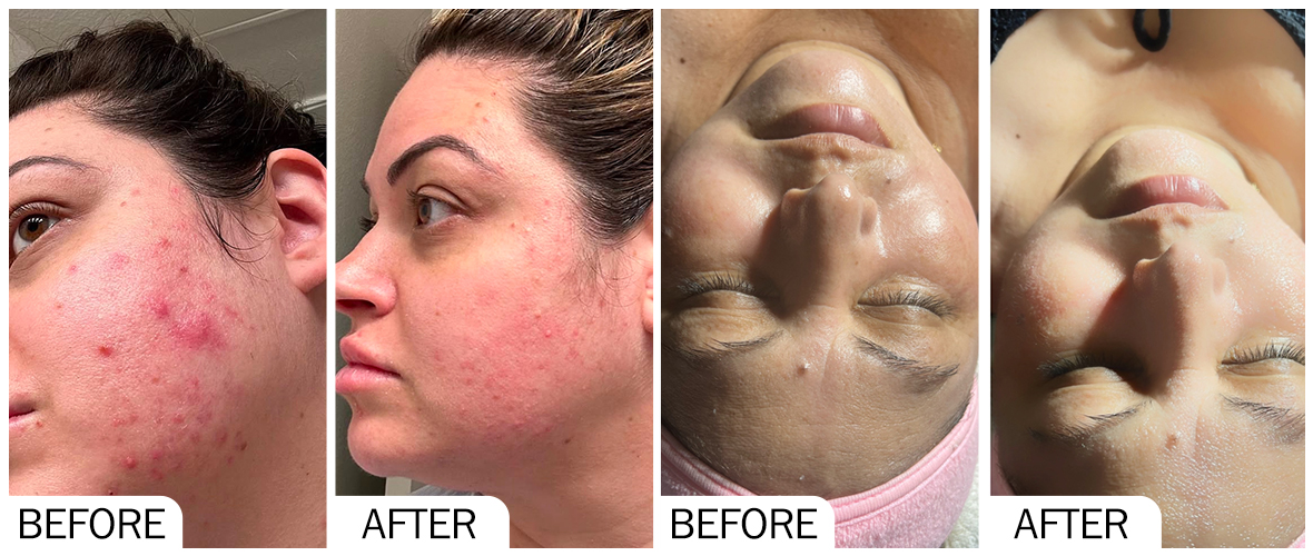 Before and After SKINBOOSTER AOMA