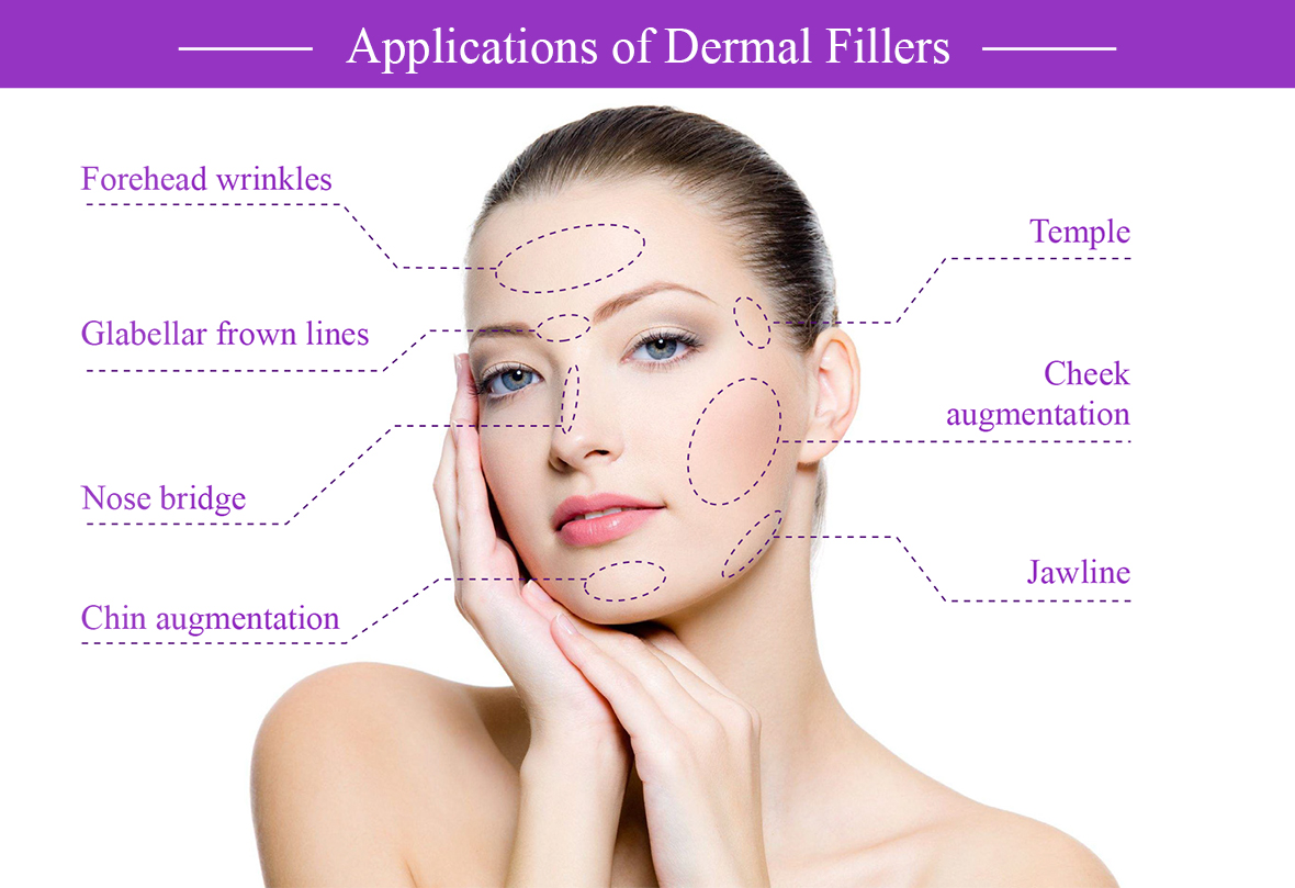 Dermal Filler Areas