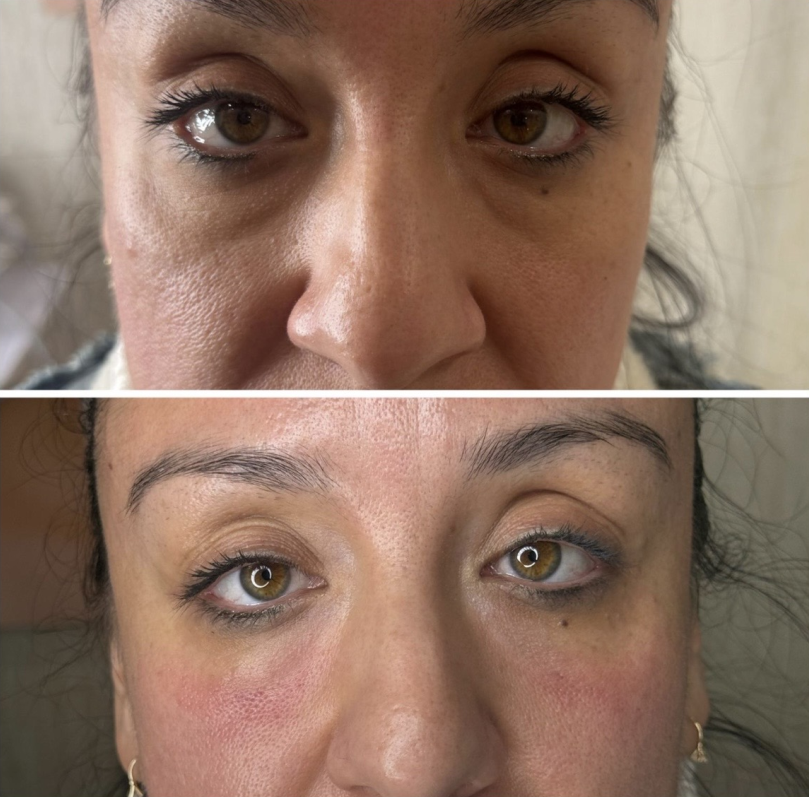 AOMA COLLAGEN LIFT INJECTION Before And After