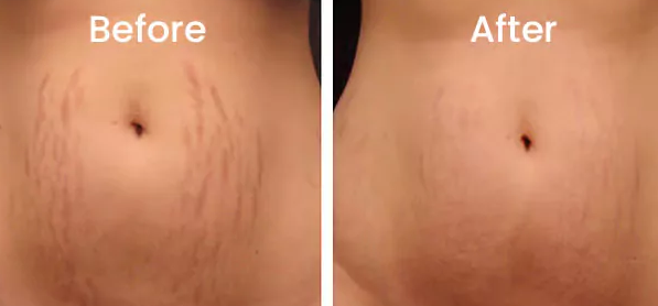 Fat Dissolving Weight Loss injection before after