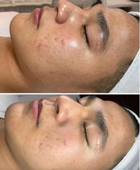 AOMA Mesotherapy facial rejuvenation before after