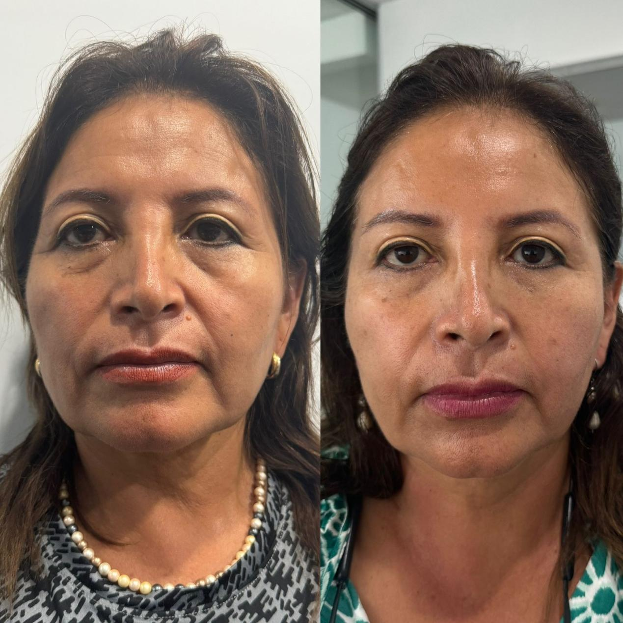 Collagen biostimulant injections before & after