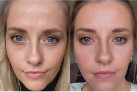 Before & after picture of AOMA Skin Booster Injection