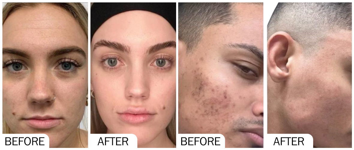 Before & After pictures of MESO Injection
