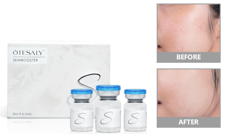 skin booster injection