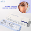Premium 2ml lidocaine injection filler mo ƒe lolome contouring .