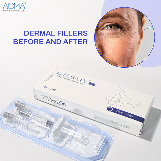 Premium 2ml lidocaine injection filler mo ƒe lolome contouring .