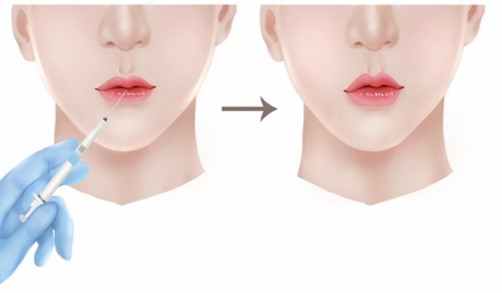 Lip Fillers_ Techniques, Longevity, Safety, and Aftercare.jpg