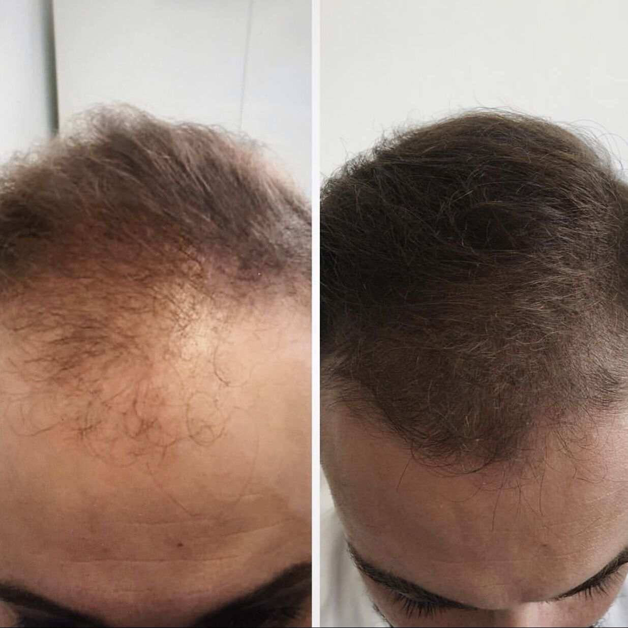 hair mesotherapy before & after