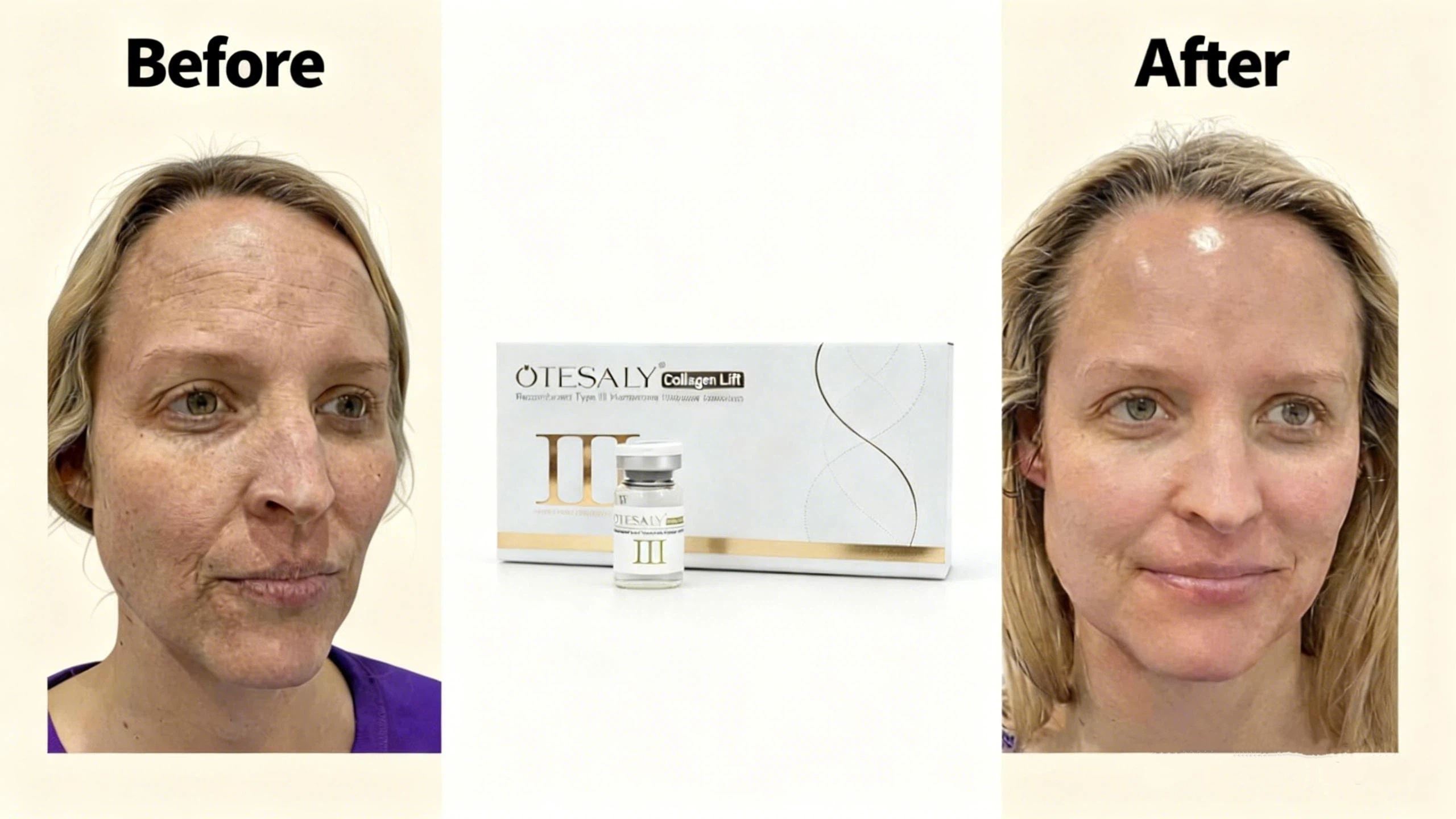 Collagen Lift Mesotherapy Comparison Chart AOMA