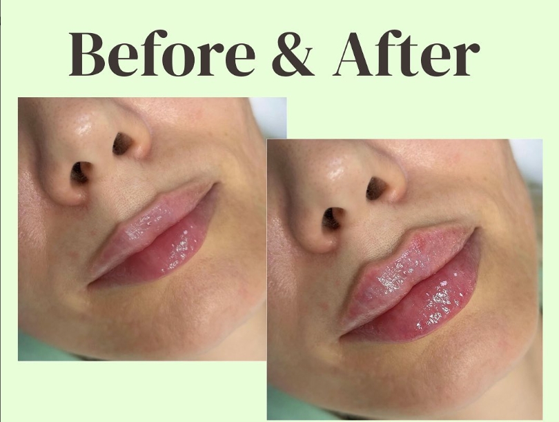 lip fillers.jpg