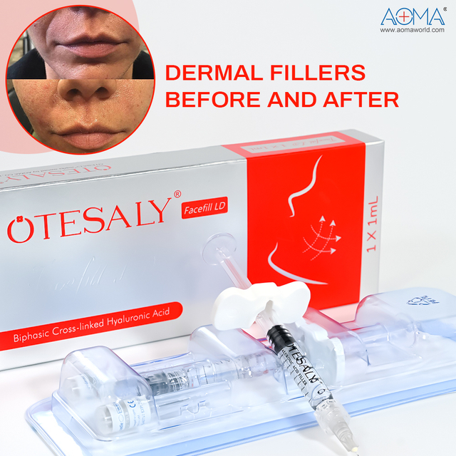 Medical Spa 1ml Lidocaine Dermal Filler Wrinkle Reduction