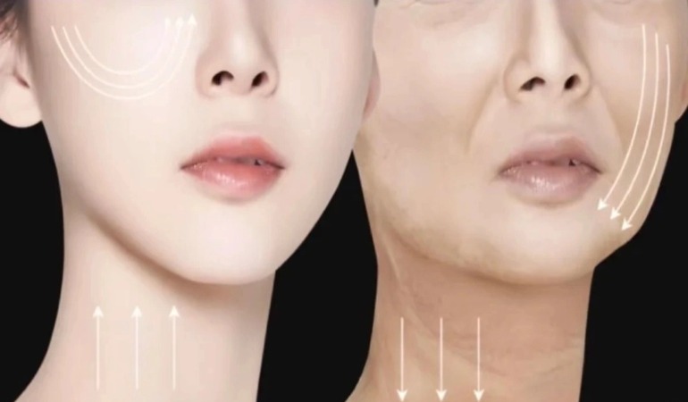 Midface Contour Restoration_ A Clinical Case Study on Cheek Augmentation Correction with HA Fillers.jpg