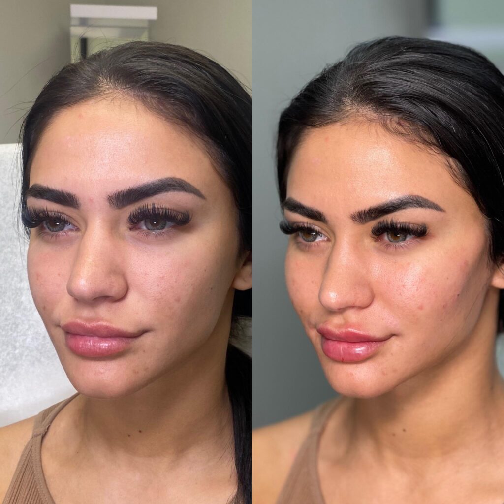 Cheek Filler Before & After – Clearwater & Tampa Bay Area