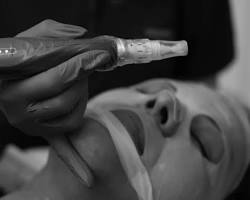 microneedling-with-pdrn-skin-rejuvenation.jpg